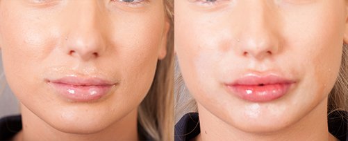 Dermal Filler in Lips before and after