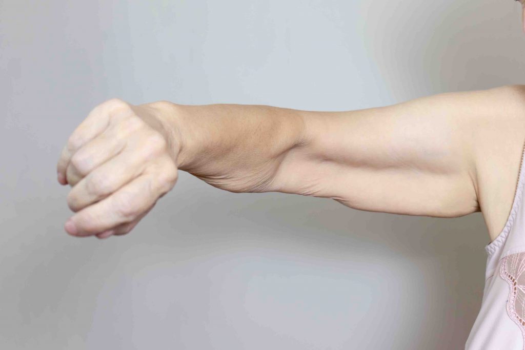 invisible arm lift surgery australia