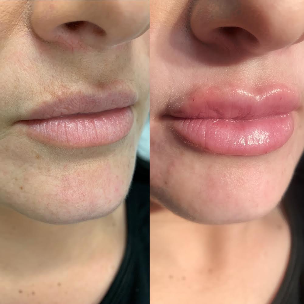 lip filler lip filler