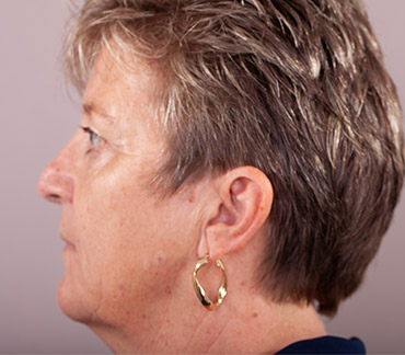 Facelift Facial Rejuvenation Surgery | Gold Coast Plastic Surgery