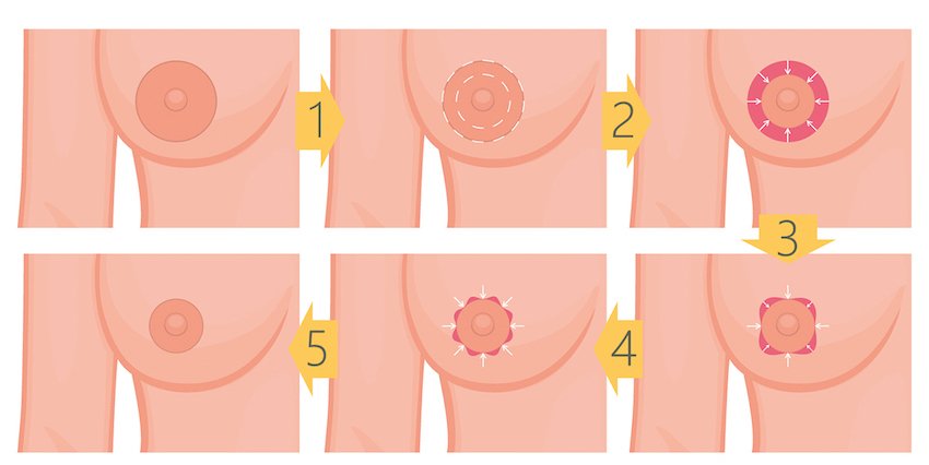 areola reduction surgery northern rivers nsw