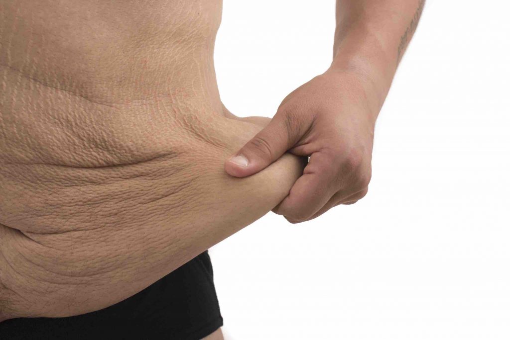 belt lipectomy plastic and cosmetic surgery brisbane gold coast