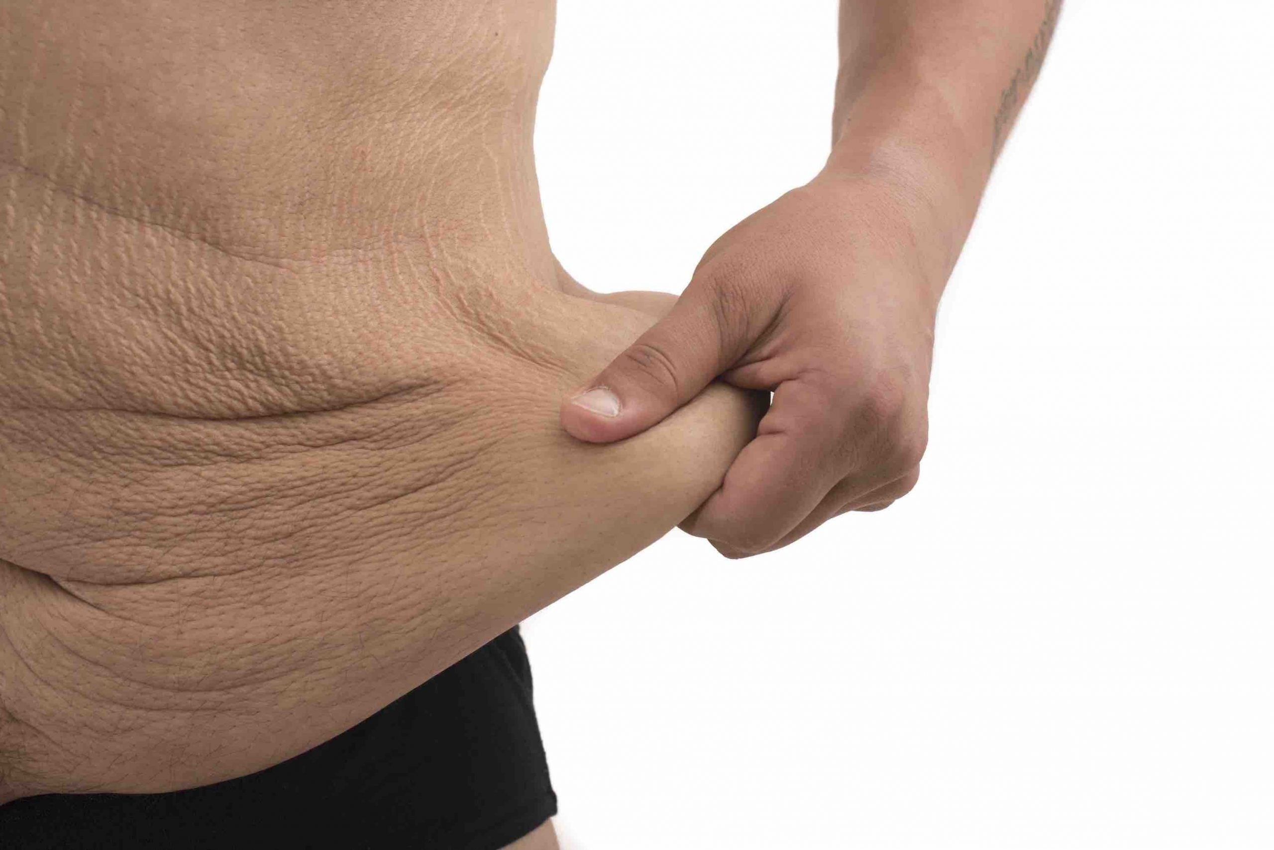 belt lipectomy plastic and cosmetic surgery brisbane gold coast