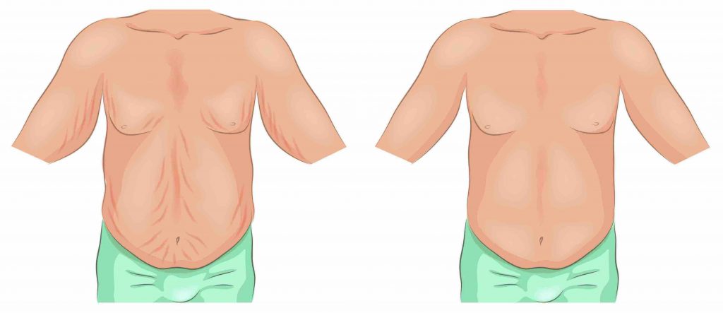 removal of excess skin after weight loss belt lipectomy procedure northern rivers
