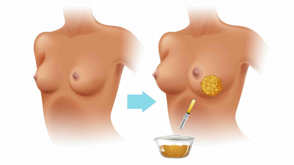 hybrid breast augmentation queensland gold coast