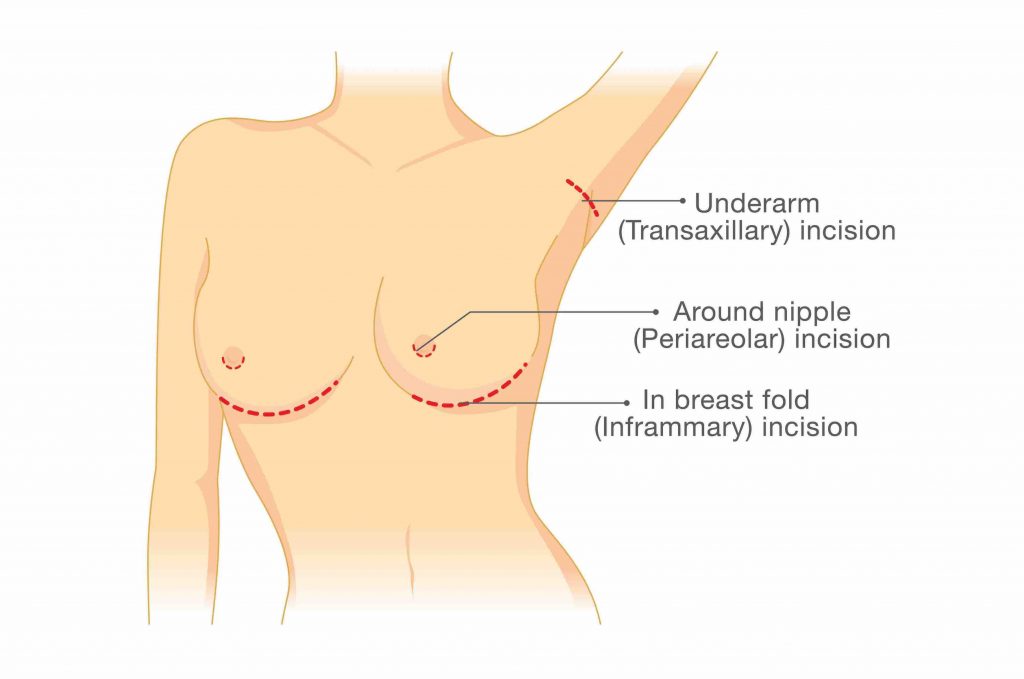types of breast augmentation techniques boob job plastic surgery