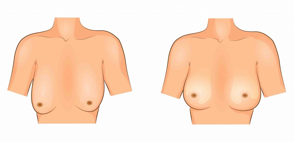 anchor breast lift procedure cosmetic surgery brisbane