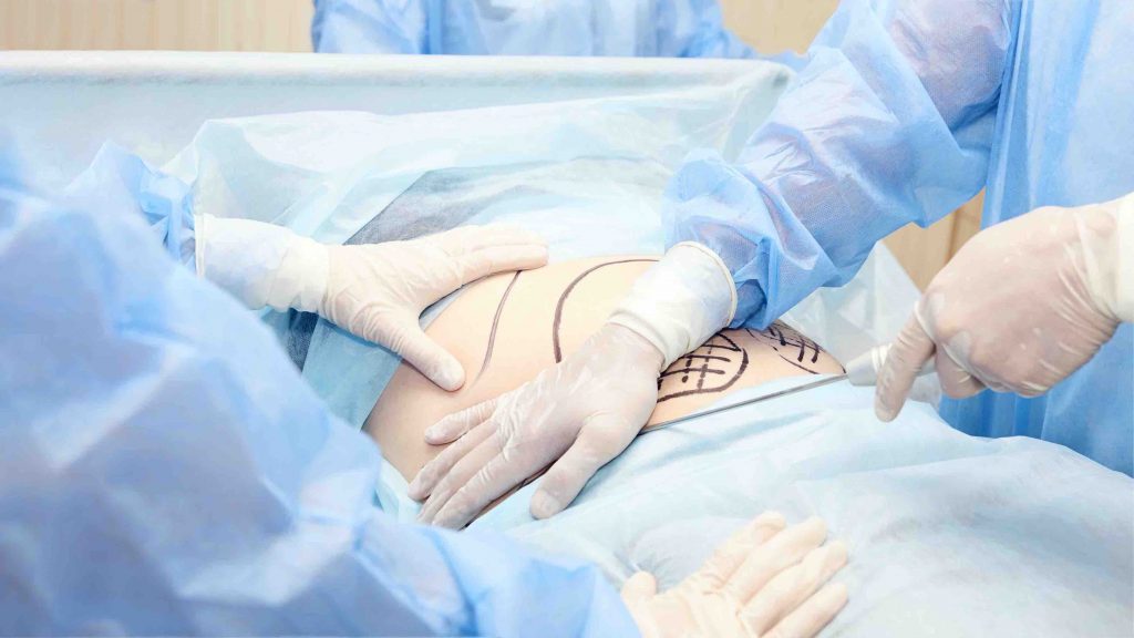 can i get a tummy tuck if im overweight?