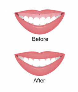 lip flip botox near me