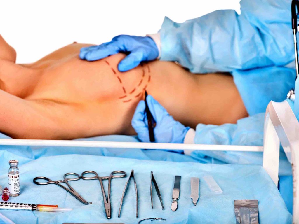 lollipop breast lift surgery technique cosmetic breast surgery