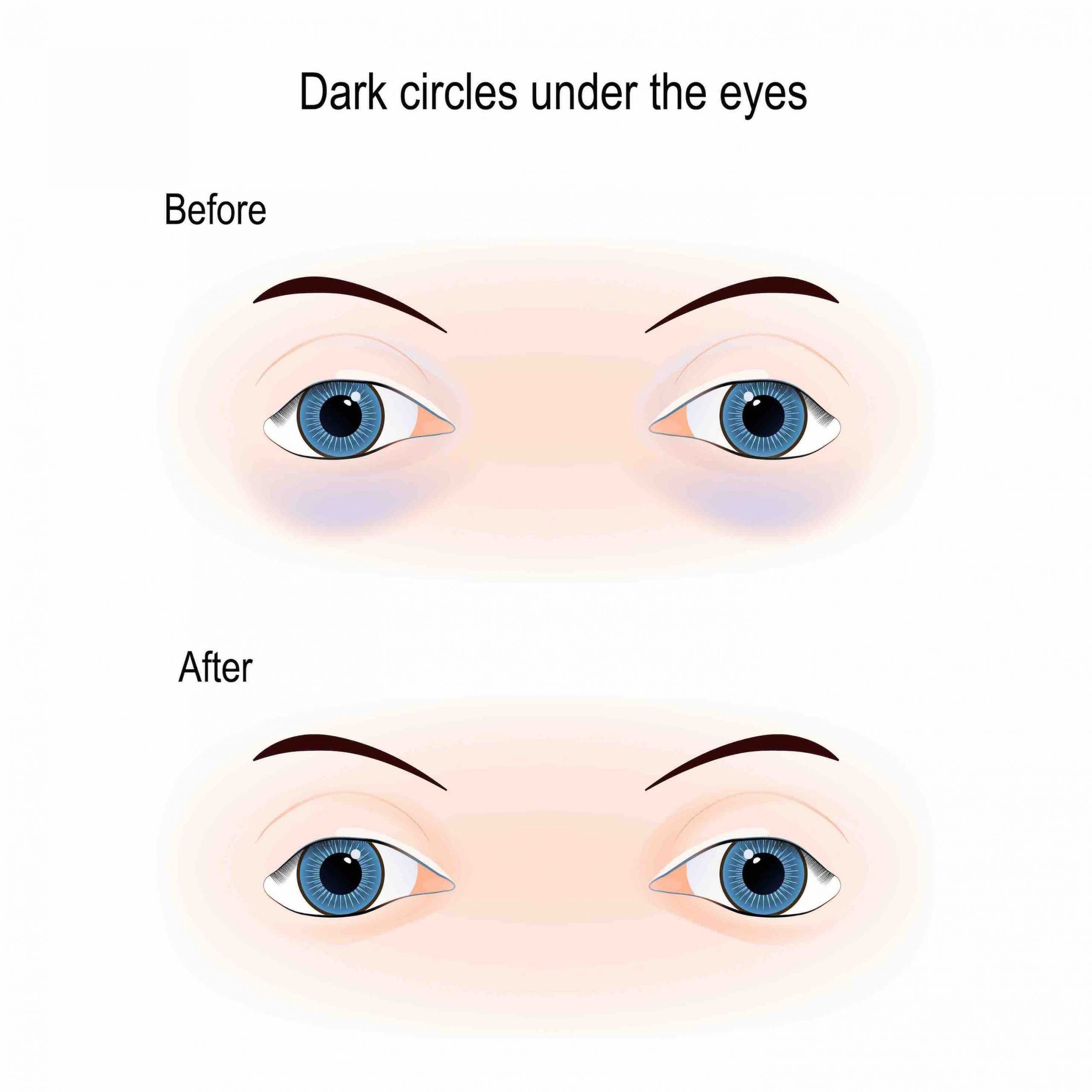 tear trough fillers near me