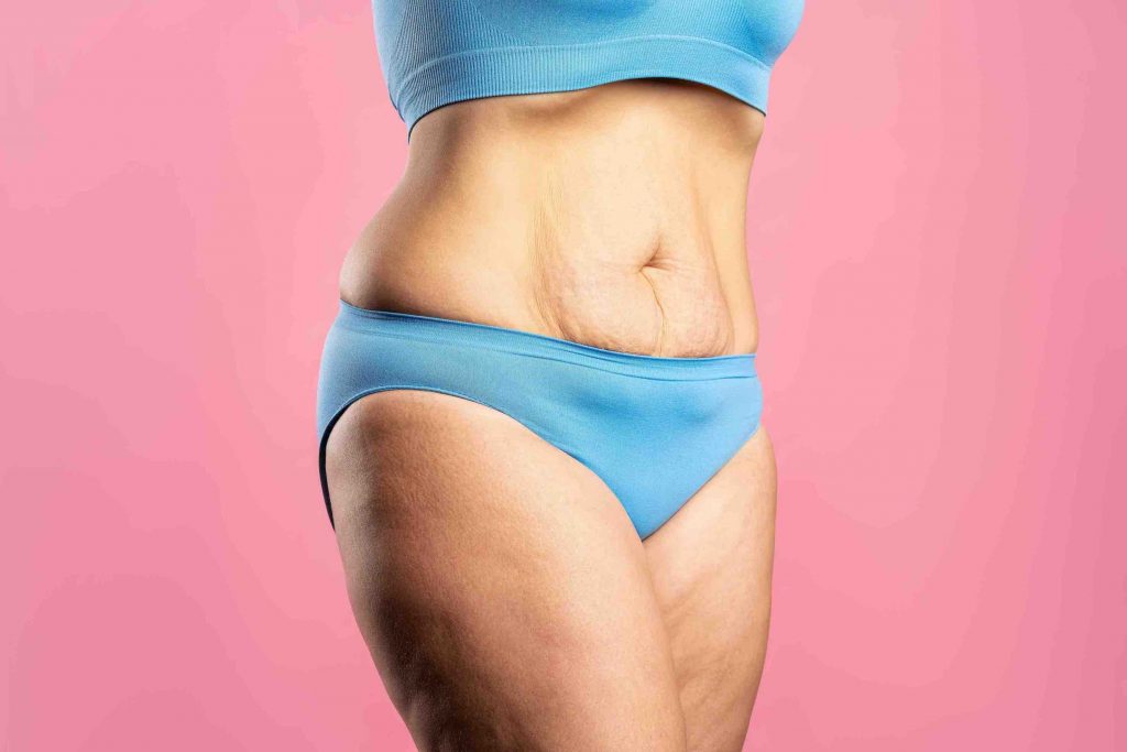 tummy tuck after pregnancy weight loss