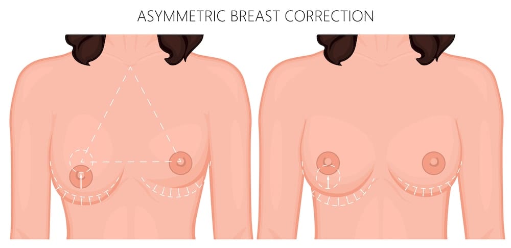 asymmetrical breast treatment gold coast