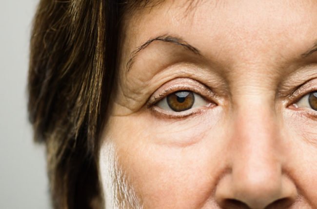 droopy eyelid medicare brisbane clinic